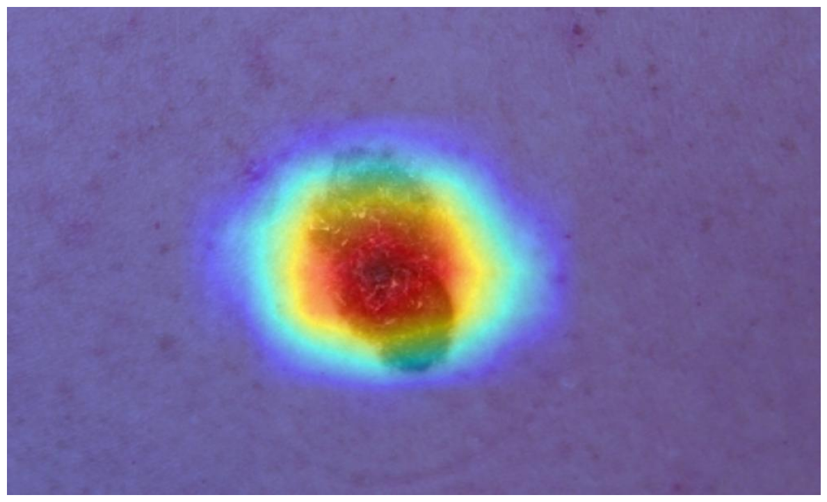Decoded explainability heatmap overlaid on the original lesion image